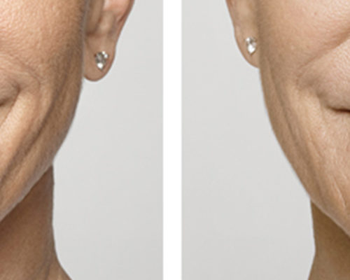 before&after(1) Augmentation des lèvres avant et après