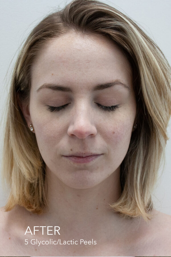 Professional chemical peel treatment at Dermamode in Montreal