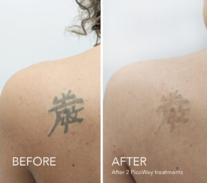 PicoTATTOObefore-and-after-SHOULDERFR