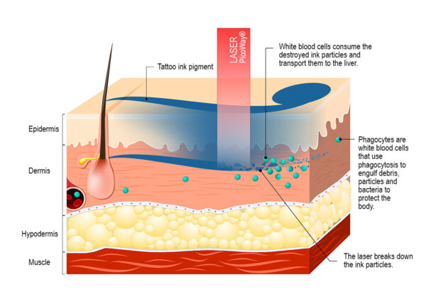 Laser Tattoo Removal Treatments in Montreal at Dermamode Clinic