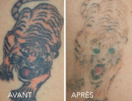 PicoTATTOOTracyPost5TbeforeafterFR
