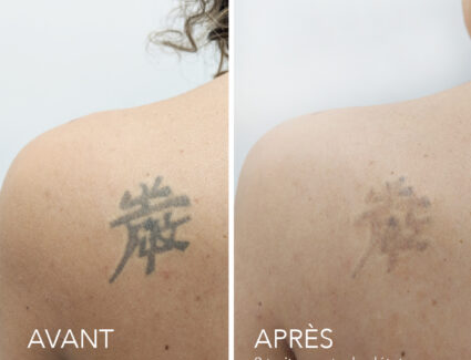 PicoTATTOObefore-and-after-SHOULDERFR-2 (1)