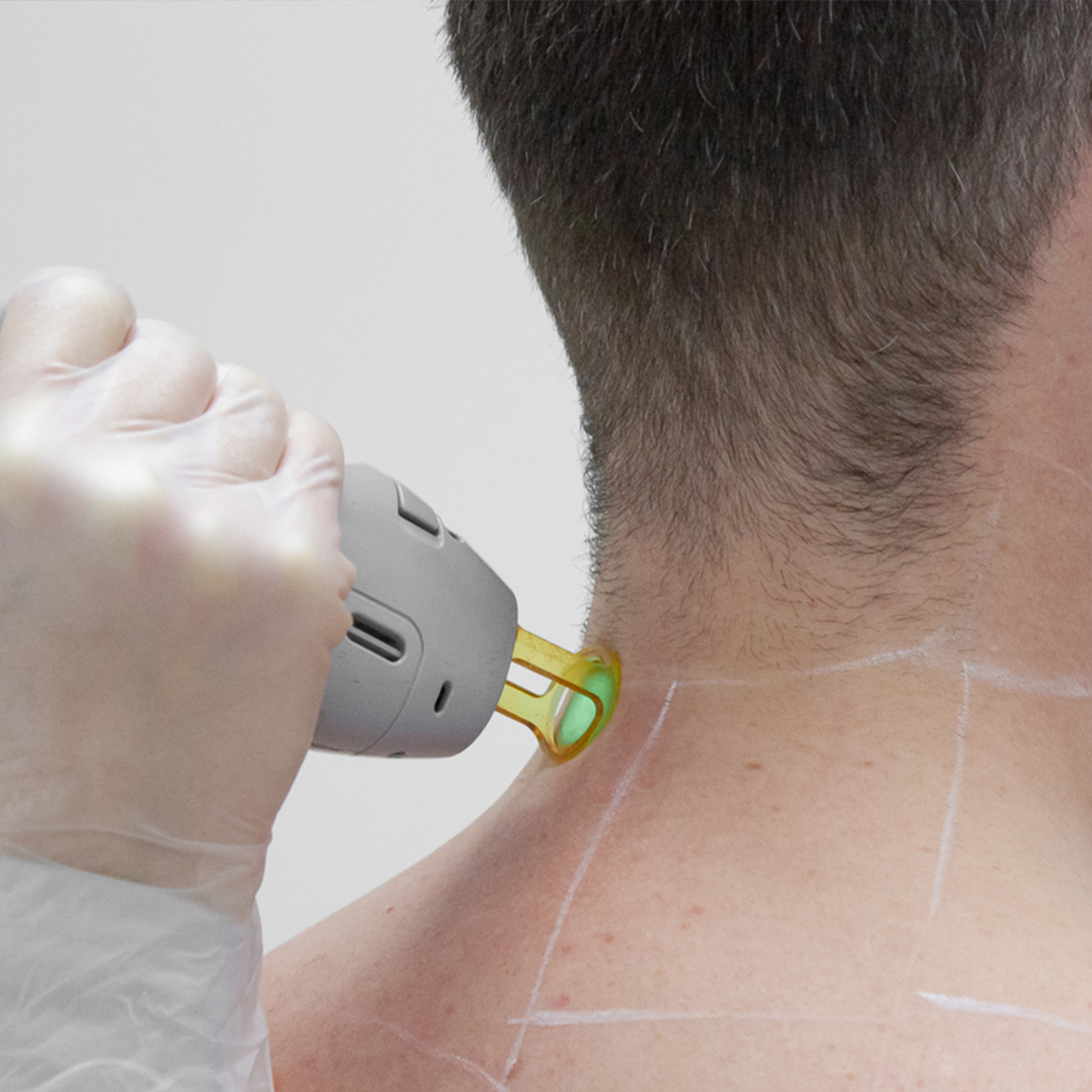 Laser Hair Removal Treatment Montreal Dermamode Clinic