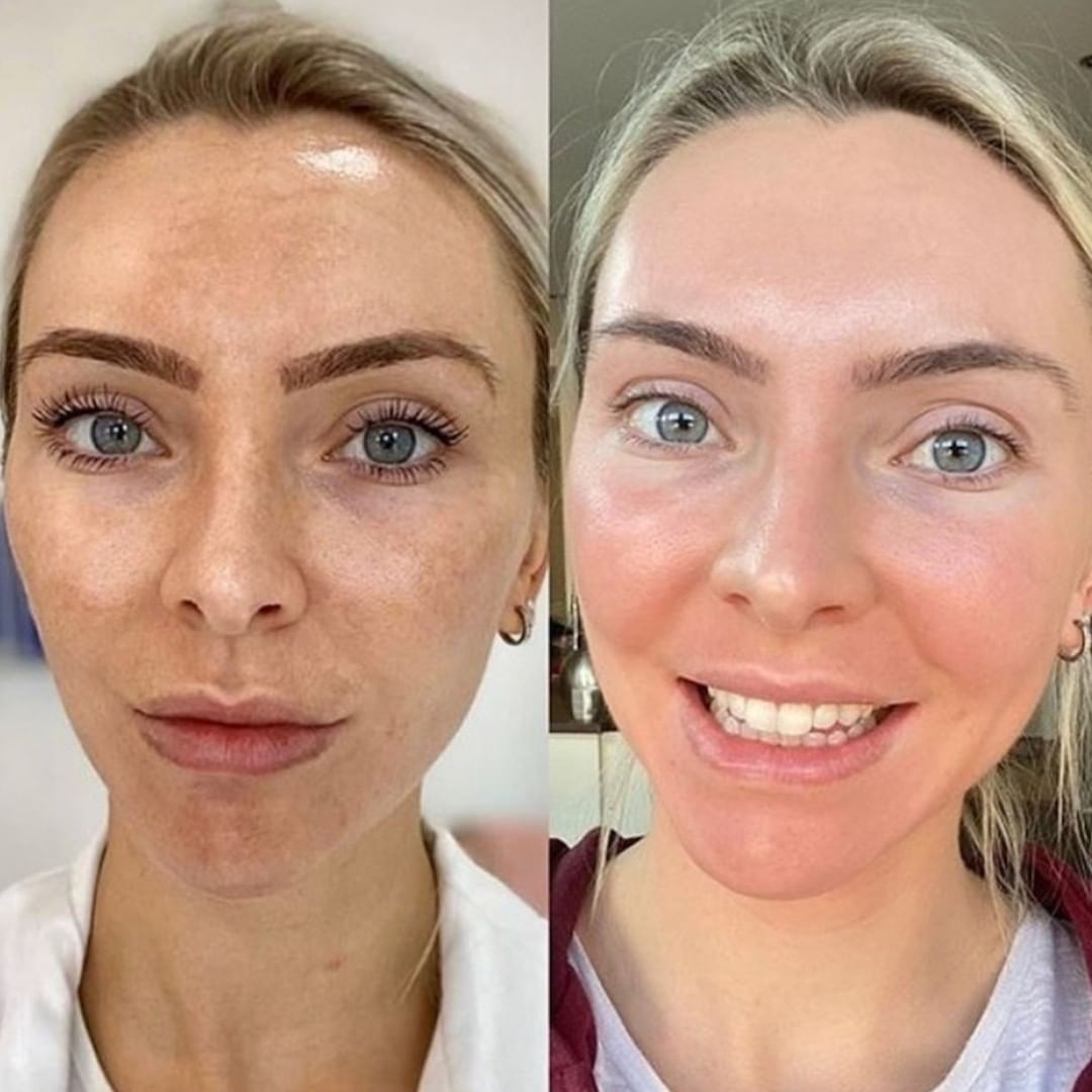 Cosemelan® Peel at Dermamode in Montreal