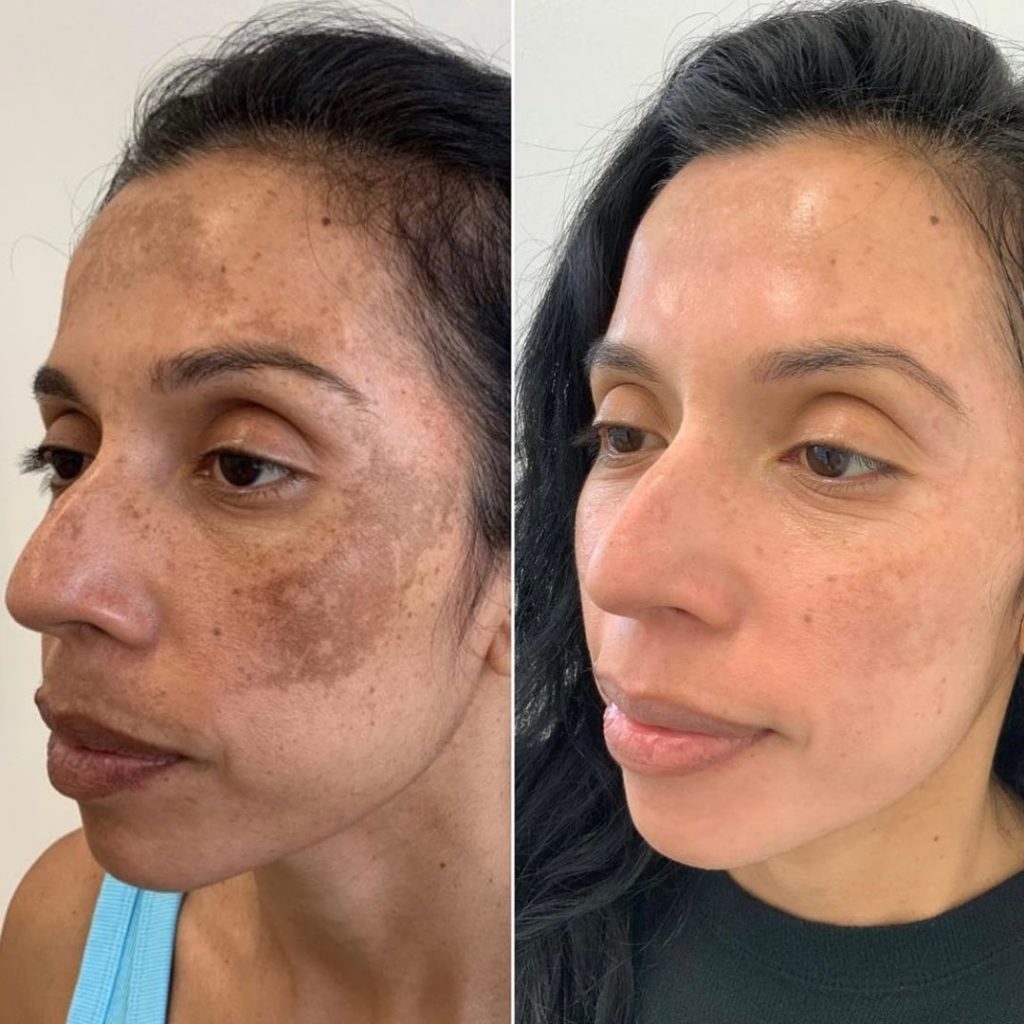 Cosemelan® Peel at Dermamode in Montreal